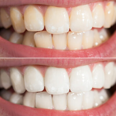 4 Teeth Whitening Products for Best Results