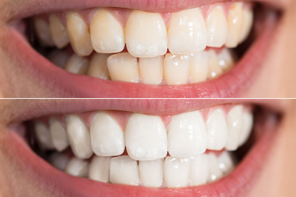 4 Teeth Whitening Products for Best Results