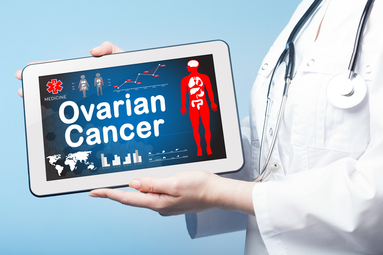 Ovarian Cancer &#8211; Symptoms and Treatment Methods